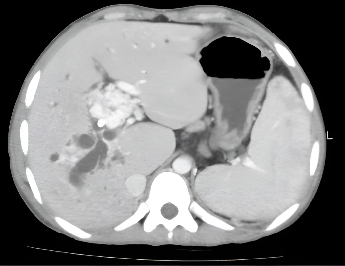 Depiction of portal venous system with PVT.