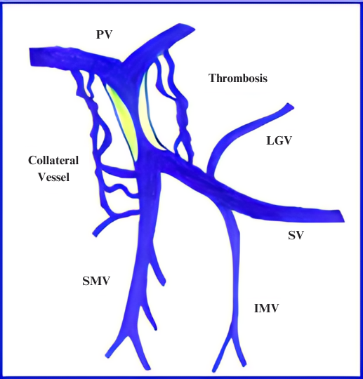 Depiction of portal venous system with PVT.